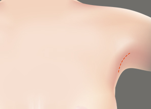 Breast Surgery at BongBong Plastic Surgery in Seoul, Korea