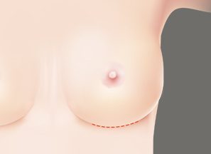 Breast Surgery at BongBong Plastic Surgery in Seoul, Korea
