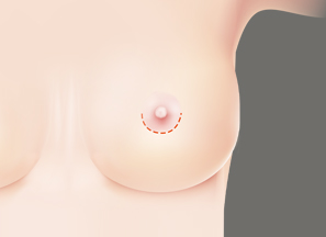 Breast Surgery at BongBong Plastic Surgery in Seoul, Korea