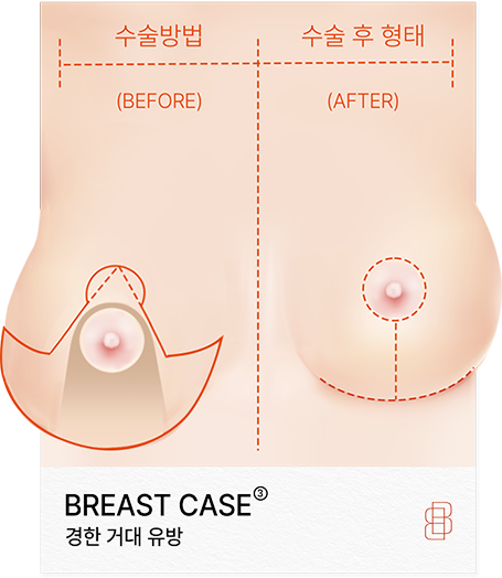 Breast Reduction in Korea at BongBong Plastic Surgery in Seoul