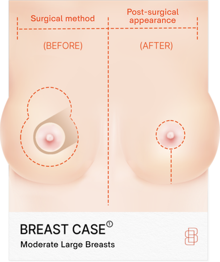 Breast Reduction in Korea at BongBong Plastic Surgery in Seoul