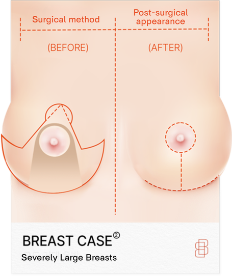 Breast Reduction in Korea at BongBong Plastic Surgery in Seoul