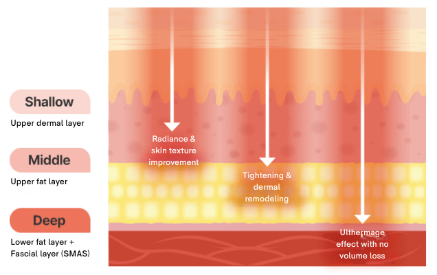 Laser Lifting in Korea at BongBong Plastic Surgery in Seoul