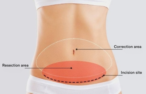 Tummy Tuck (Abdominoplasty) in Korea at BongBong Plastic Surgery in Seoul
