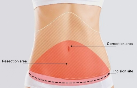 Tummy Tuck (Abdominoplasty) in Korea at BongBong Plastic Surgery in Seoul
