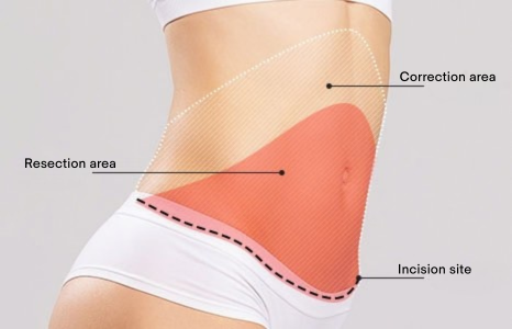 Tummy Tuck (Abdominoplasty) in Korea at BongBong Plastic Surgery in Seoul