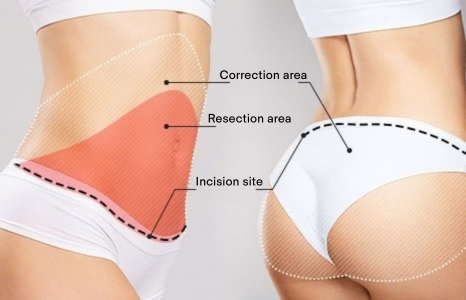 Tummy Tuck (Abdominoplasty) in Korea at BongBong Plastic Surgery in Seoul