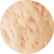 Scar and Stretch Mark Treatment in Korea at BongBong Plastic Surgery in Seoul