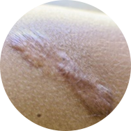 Scar and Stretch Mark Treatment in Korea at BongBong Plastic Surgery in Seoul
