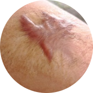 Scar and Stretch Mark Treatment in Korea at BongBong Plastic Surgery in Seoul