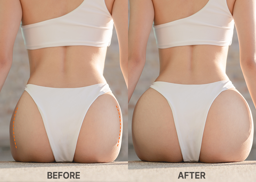 Buttocks Filler in Korea at BongBong Plastic Surgery in Seoul
