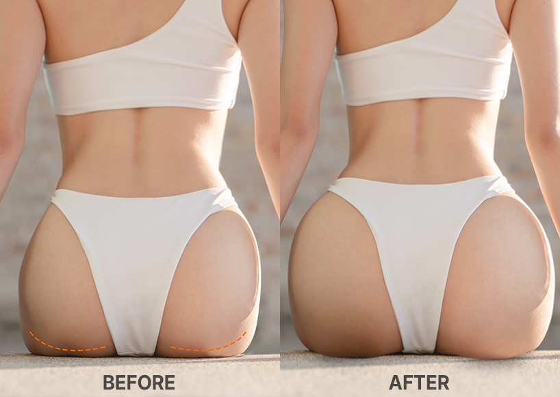 Buttocks Filler in Korea at BongBong Plastic Surgery in Seoul