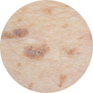 Scar and Stretch Mark Treatment in Korea at BongBong Plastic Surgery in Seoul