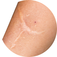 Scar and Stretch Mark Treatment in Korea at BongBong Plastic Surgery in Seoul